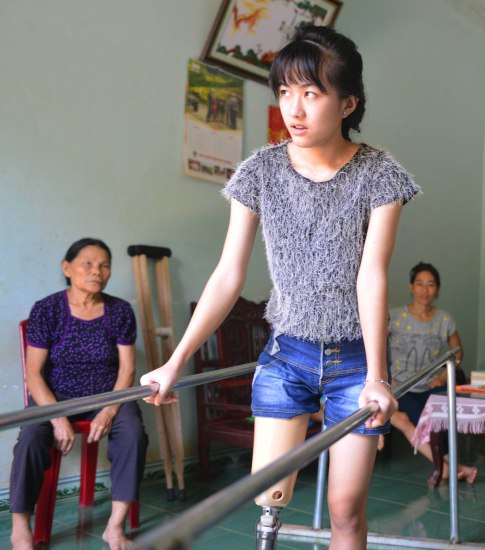 Bà nội và mẹ lo lắng dõi theo từng bước đi chập chững với chân giả của Vi