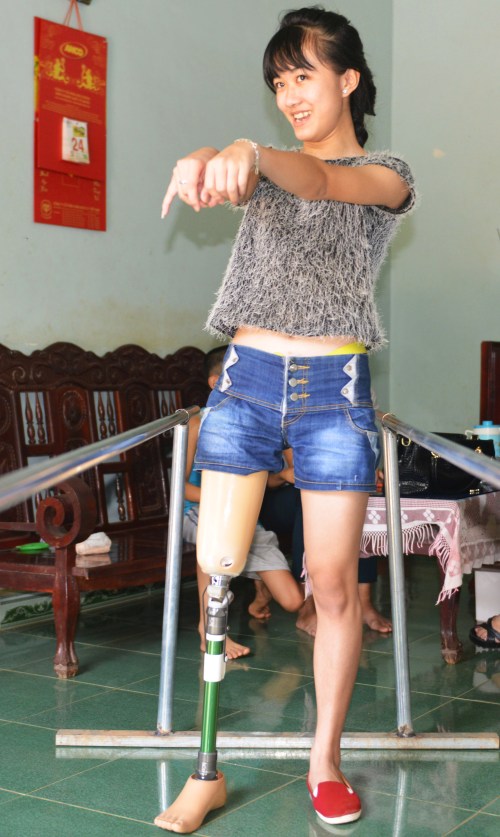 Giữ thăng bằng khi tập đi với chân giả