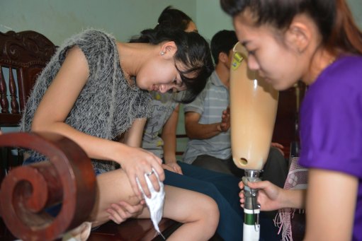 Vết thương ở mỏm cụt vẫn còn đau buốt