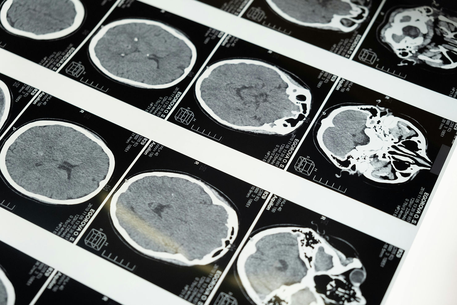 A photo of printed black and white brain scans.